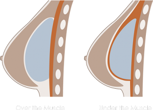 Implant Placement